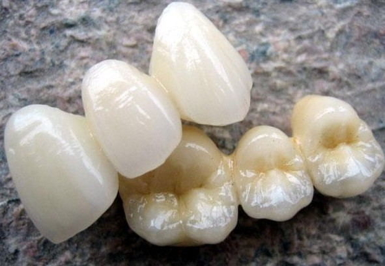 背部歯の復帰のために溶ける高いBiocompatibility PFMの王冠の磁器