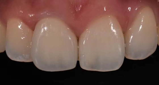 背部歯の復帰のために溶ける高いBiocompatibility PFMの王冠の磁器