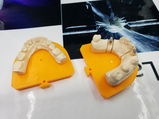 完全な金属PFMの歯科王冠橋ハイテクな生物的材料