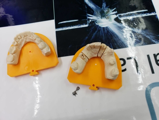 完全な金属PFMの歯科王冠橋ハイテクな生物的材料