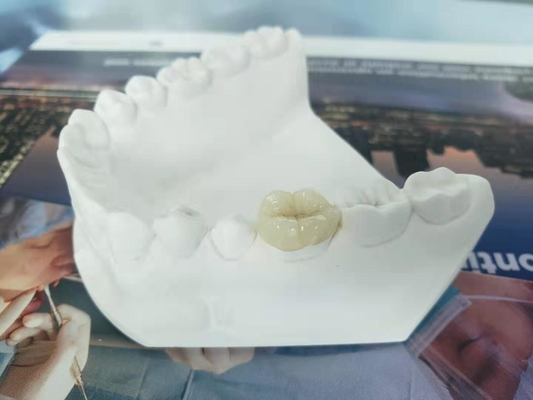 耐久のFDAの類似した全陶磁器の歯科王冠のベニヤの象眼細工の上張り