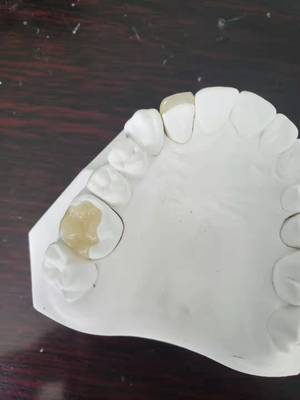 耐久のFDAの類似した全陶磁器の歯科王冠のベニヤの象眼細工の上張り