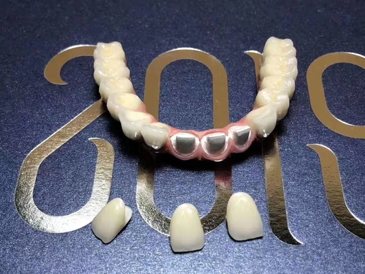 Resin-Based CAD-CAMは取り外し可能な橋美学の復帰を固定した