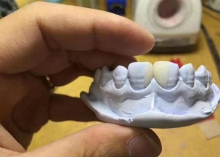 有効な樹脂取り外し可能なPFMの歯科王冠の健康材料