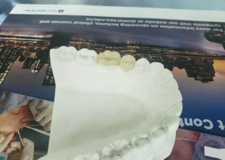 耐久の適用範囲が広いPFM橋王冠歯科IPS Eの最高の出版物の象眼細工の上張り