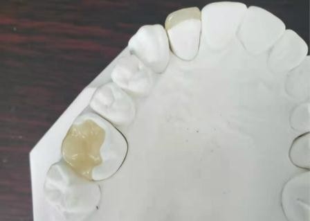 耐久の適用範囲が広いPFM橋王冠歯科IPS Eの最高の出版物の象眼細工の上張り