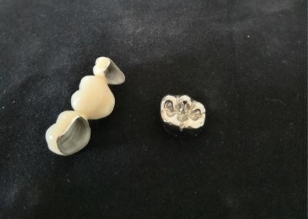 OEMの磨く磁器の歯科王冠高い生物的Intermiscibility