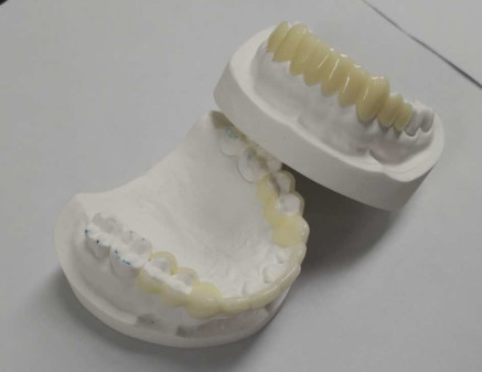 高耐久性CADCAM3D印刷テンポラリークラウン耐久性レジン