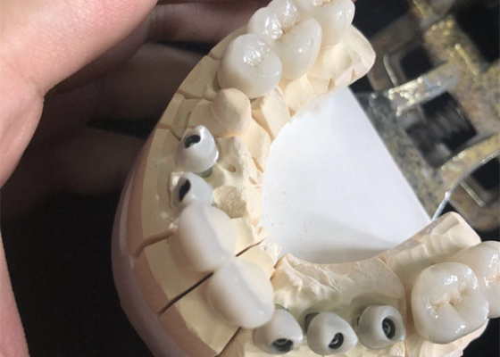 金属の自由で白いジルコニアの歯科王冠優秀なBiocompatibility