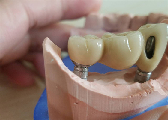 チタニウムの基礎ジルコニアの迫台が付いているCAD CAMのジルコニアの歯科王冠