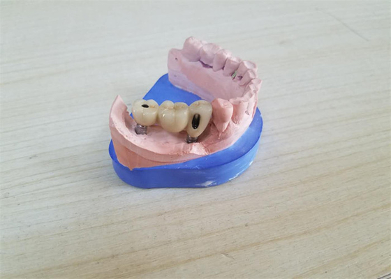 チタニウムの基礎ジルコニアの迫台が付いているCAD CAMのジルコニアの歯科王冠
