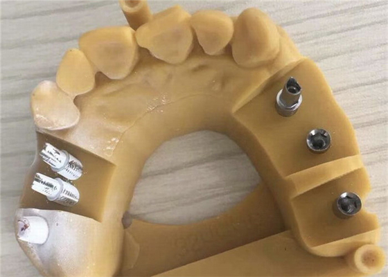 一時的な王冠を印刷するデジタルBiocompatibility PFM歯科王冠3D