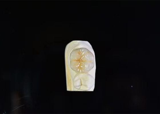 超強度 ポルセラン 歯冠 高生物学的混合性