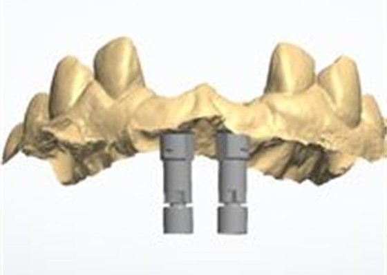 精密なCAD/CAMデザイン シルコニア歯冠