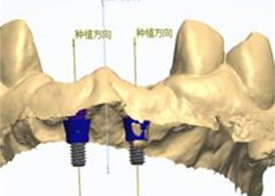 3Dモデル ジルコニアの冠