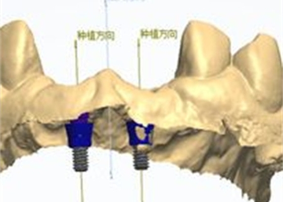 精密なCAD/CAMデザイン シルコニア歯冠